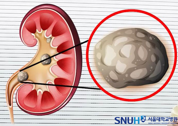 요로결석의 발생. (사진=서울대학병원 제공)